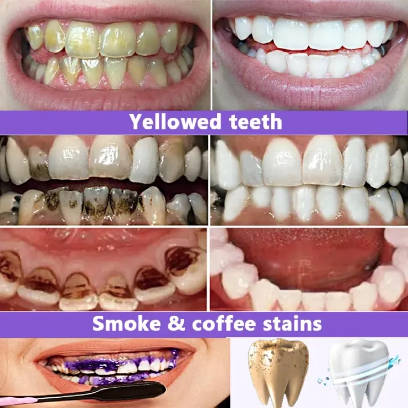 2026 Bestselling Whitening Too - огляд і ціна Teeth Whitening Effective