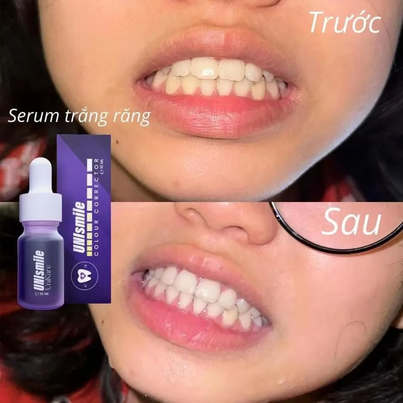 Unismile Teeth Whitening Essen - огляд і ціна Teeth Whitening Effective