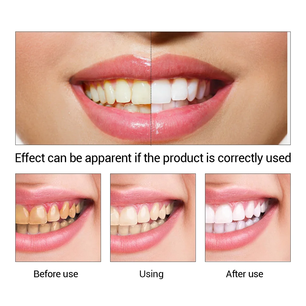 FTEENPLY Teeth Whitening Essen - огляд і ціна Teeth Whitening Ingredients