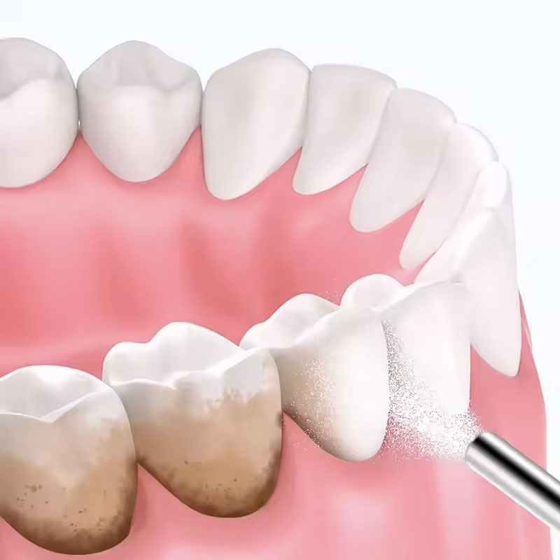 130g Dental Sandblasting Powde - огляд і ціна Teeth Whitening Ingredients