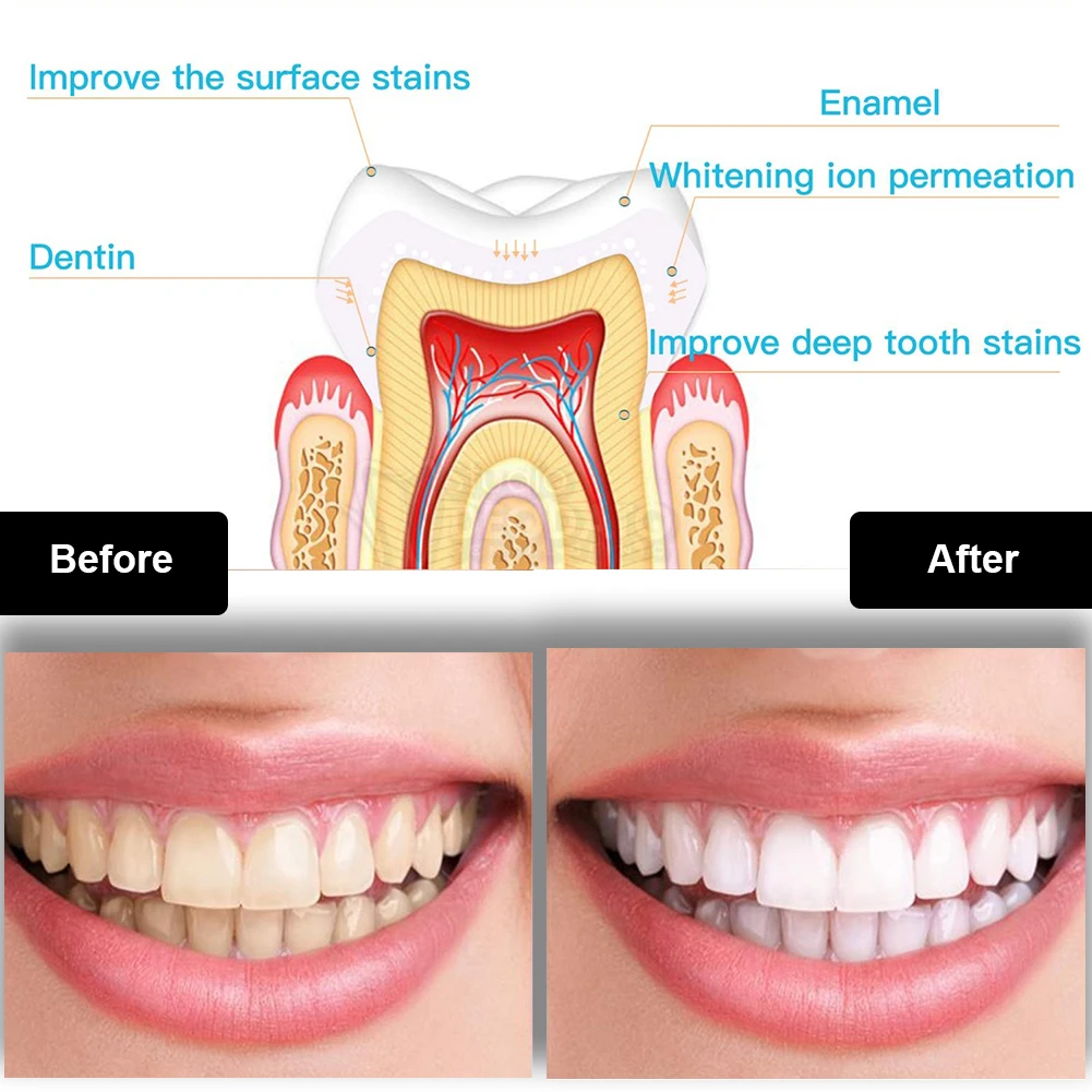 Dental Teeth Whitening Kit Min - огляд і ціна Teeth Whitening Pen